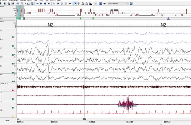 Uyku Diagnostik, Uyku Teşhis Sistemleri