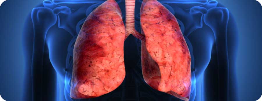 Restriktif Akciğer Hastalığı Nedir? Nelerdir?